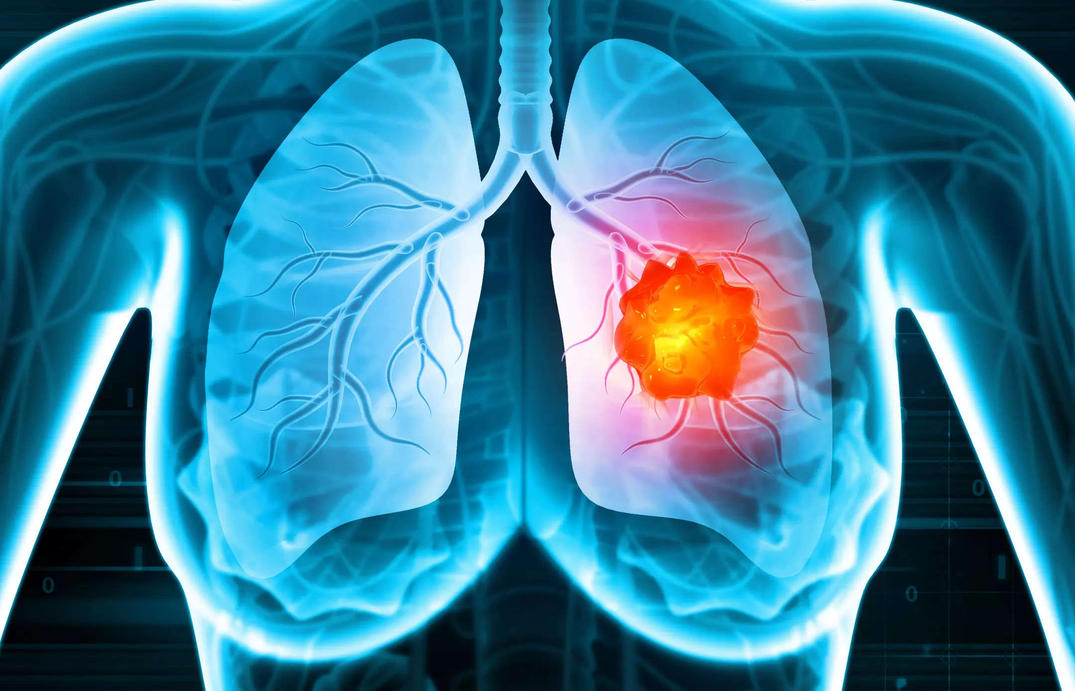 Miracle pill can keep lung cancer at bay: Report, Health News, ET  HealthWorld