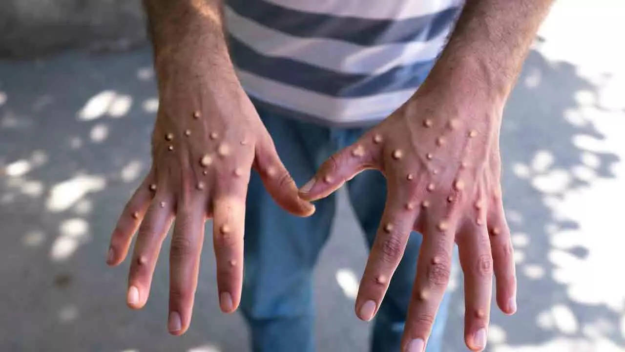 Two monkeypox cases reported in Kerala, Health News, ET HealthWorld