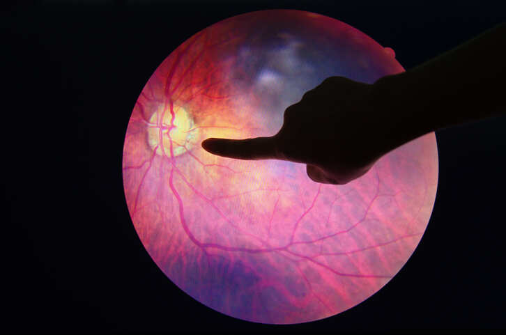 FDA approves marketing of first AI device to detect diabetic eye disease