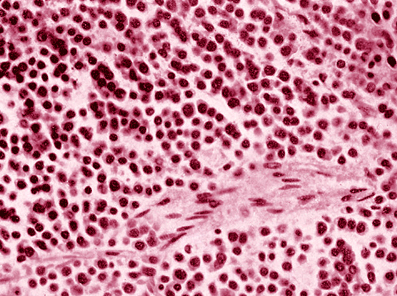 Pill that 'lights up' tumours can help detect breast cancer