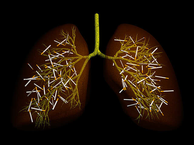 New blood test may help detect lung cancer early