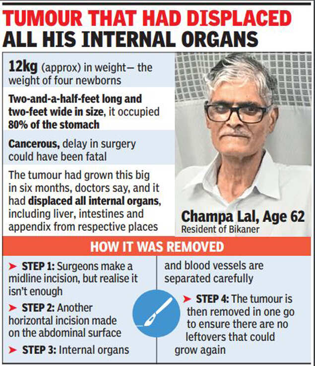 Doctors remove tumour the weight of 4 newborns from 62-year-old’s stomach