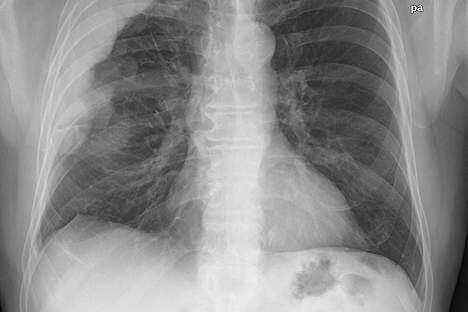 NPTEL rolls out online course on TB for doctors