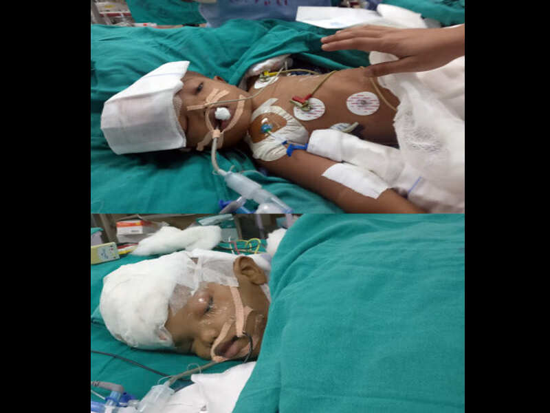 2 sets of conjoined twins come to AIIMS for surgical separation