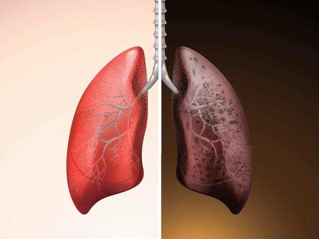Don't blame the cigarettes alone, toxic air you breathe also causes lung cancer