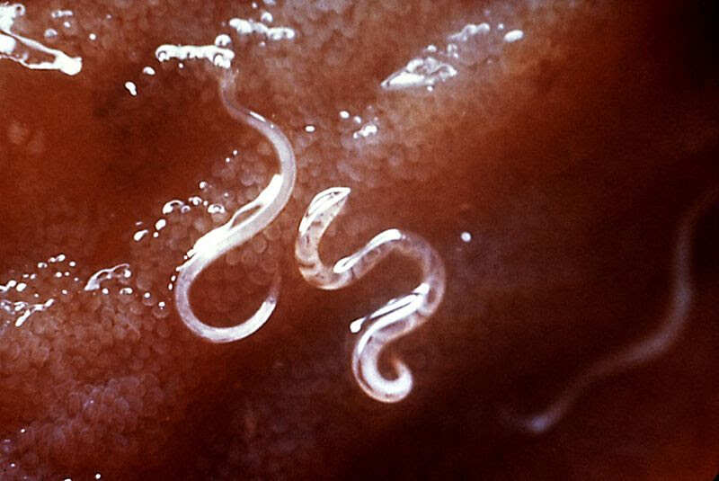 Changes in gut microbiome is only one subset of helminth-infected patients : Study
