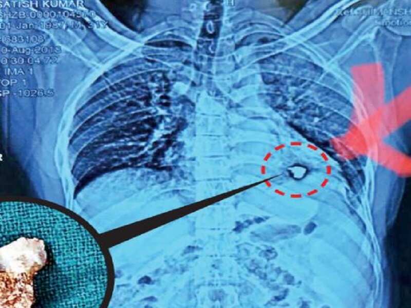 Kumar was drilling into iron at his factory. Just then, a part of it that was nearly four centimetres long, snapped and hit him on the chest like a bullet fired from a gun. 