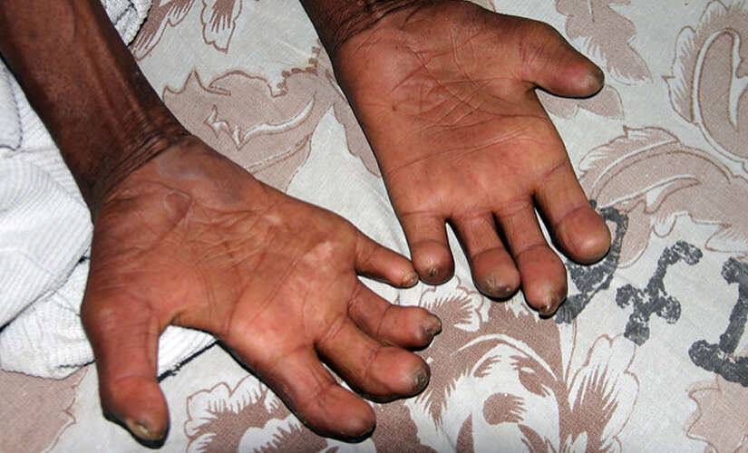 Leprosy detection drive in 8 dists from Wednesday