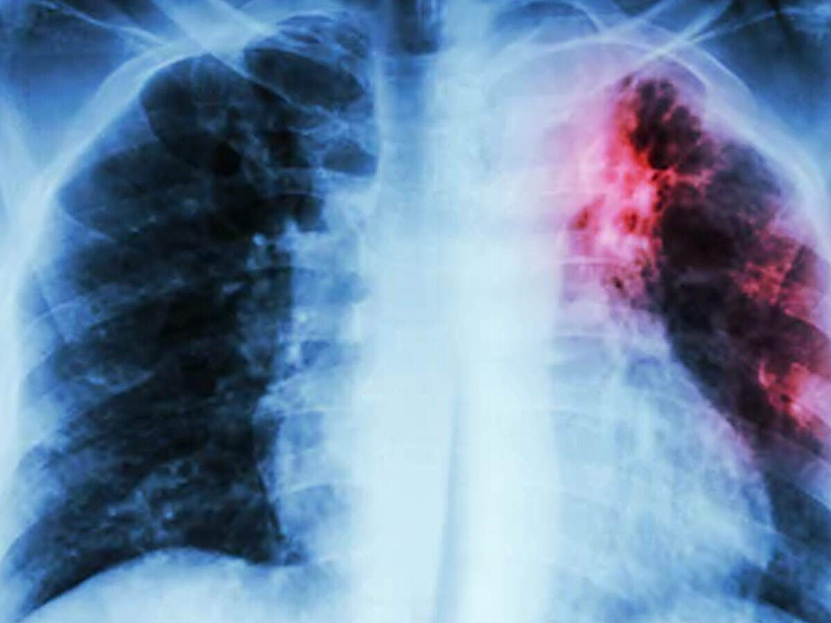 Agra: 300 tuberculosis patients identified in a span of 4 weeks