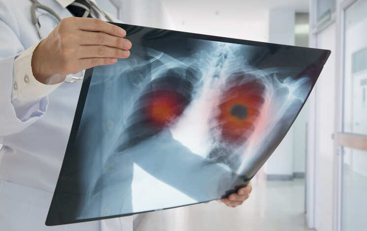 Small cell lung cancer may respond to combination therapy