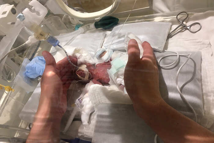 Medical marvel: Baby boy, weighing 268 grams, becomes world's smallest newborn