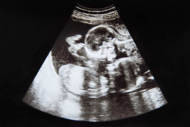 First semi-identical twins identified in pregnancy