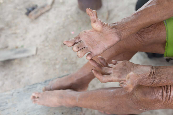 Fear of leprosy resurgence in Nepal