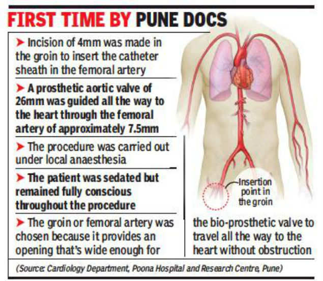 Pune: Two get prosthetic heart valves without surgery