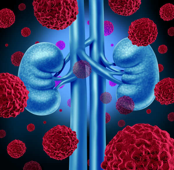 Study finds diabetes drug may prevent, slow kidney disease
