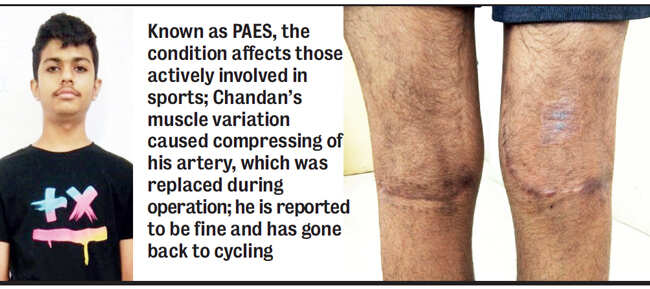 Pune: 15-year-old boy recovers from rare leg ailment after surgery