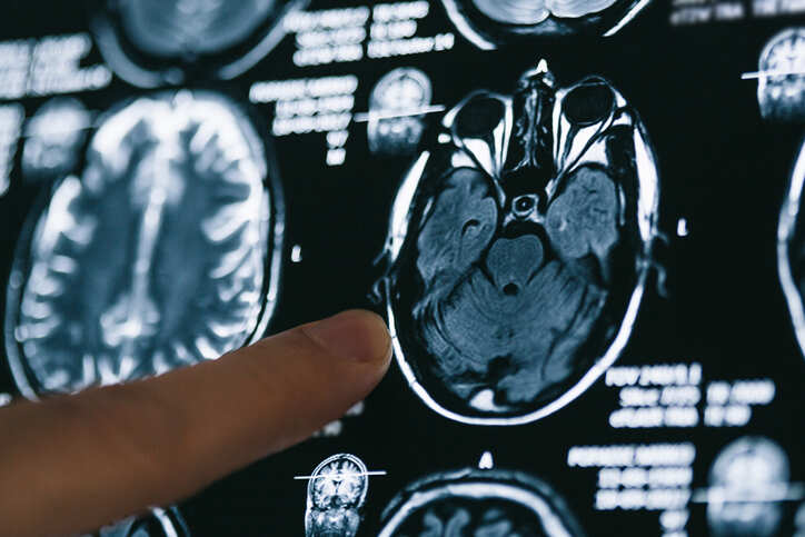 Imaging technique could enable surgeons to see and remove malignant tumour with ease: research