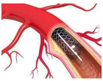 What moves the needle in favour of a Stent ? Dr. Rishi Gupta