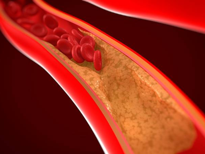Study suggests pain-free exercise for patients with clogged leg arteries