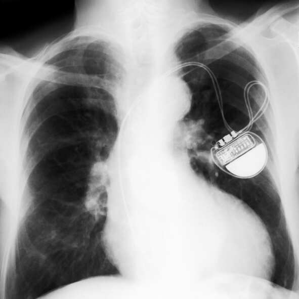 2 pacemakers fitted in a day at govt hospital in West Bengal