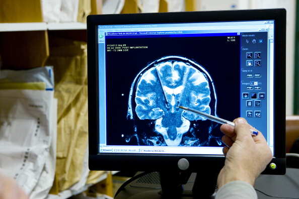 Advanced MRI brain scan can predict stroke-related dementia: Study