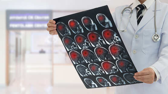 Using stem cells to save neurons