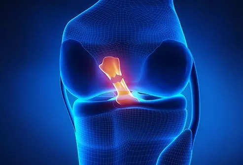 Arthroscopic surgery emerging as the new way of treating ACL injuries