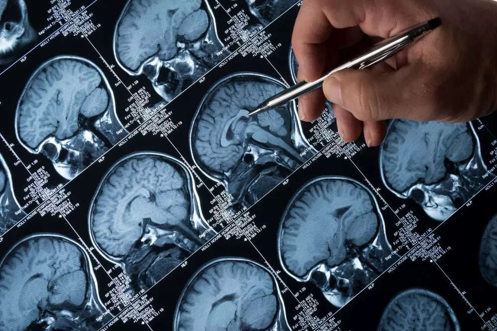 Alzheimer's-like changes seen in COVID patients' brains: Studies