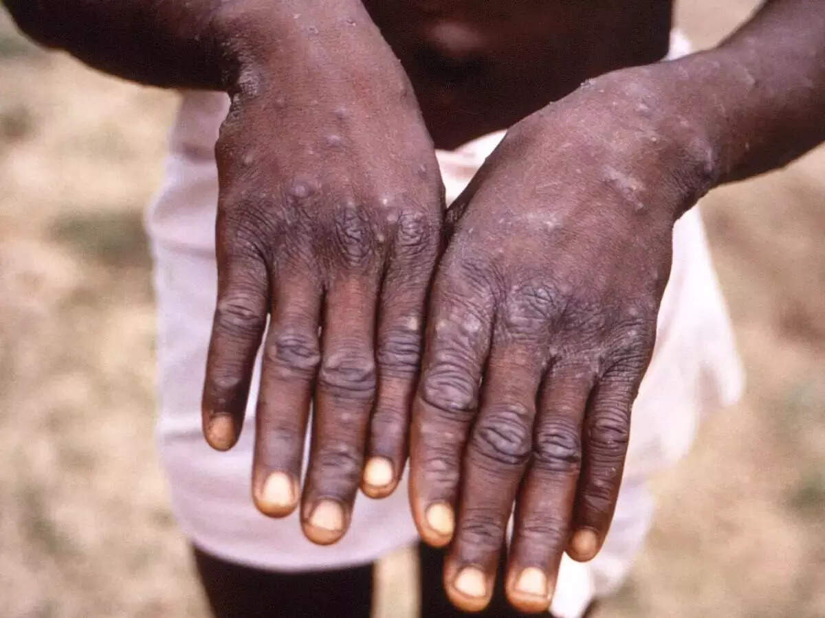 Suspected monkeypox case in Kerala, samples of traveller from UAE sent for testing