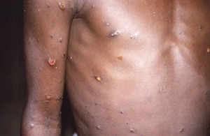 'Growing concern' of Monkeypox in India?