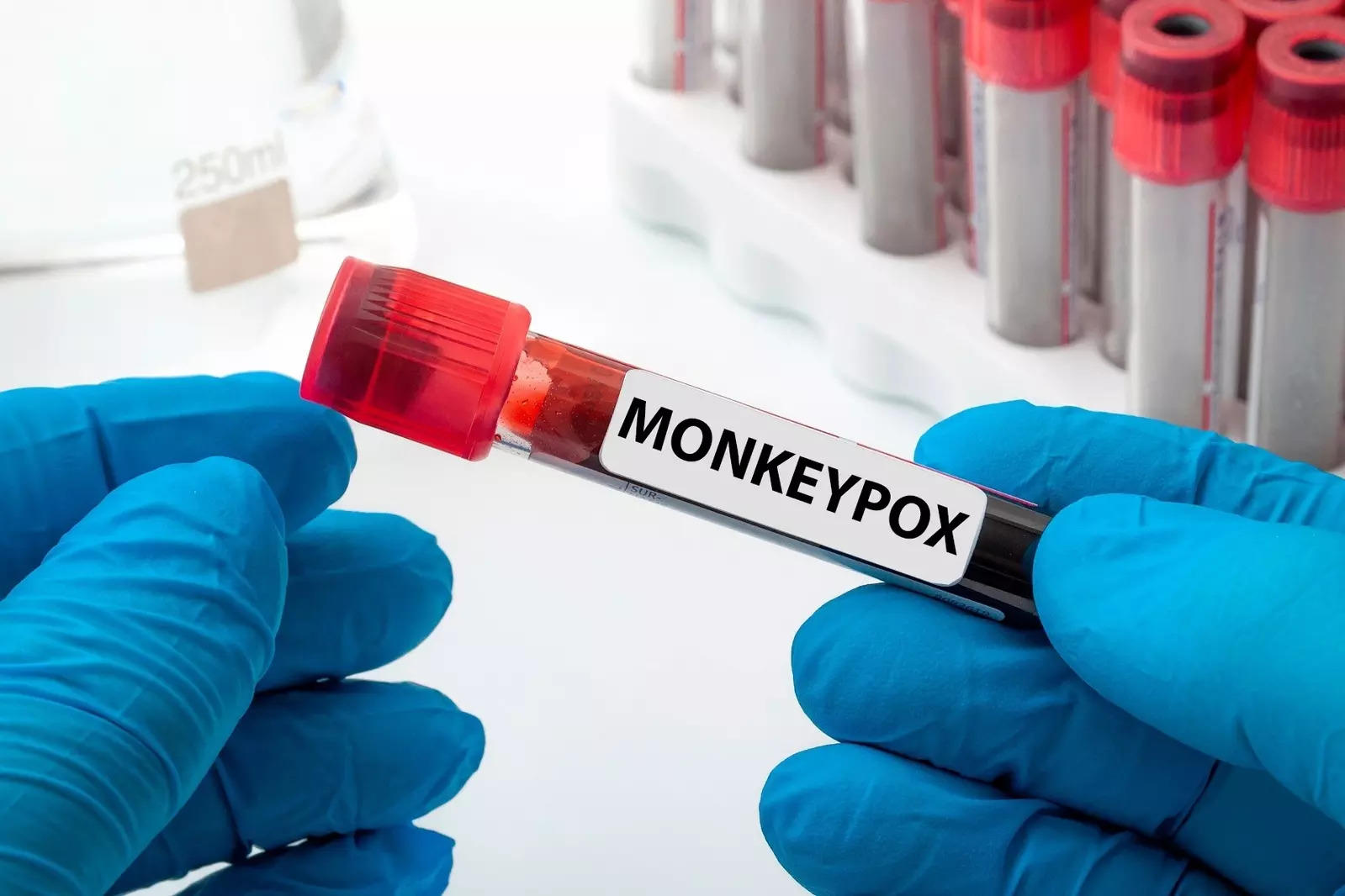 WHO: آبله میمون می تواند خود را درمان کند، اما باعث مرگ و میر بیشتر می شود