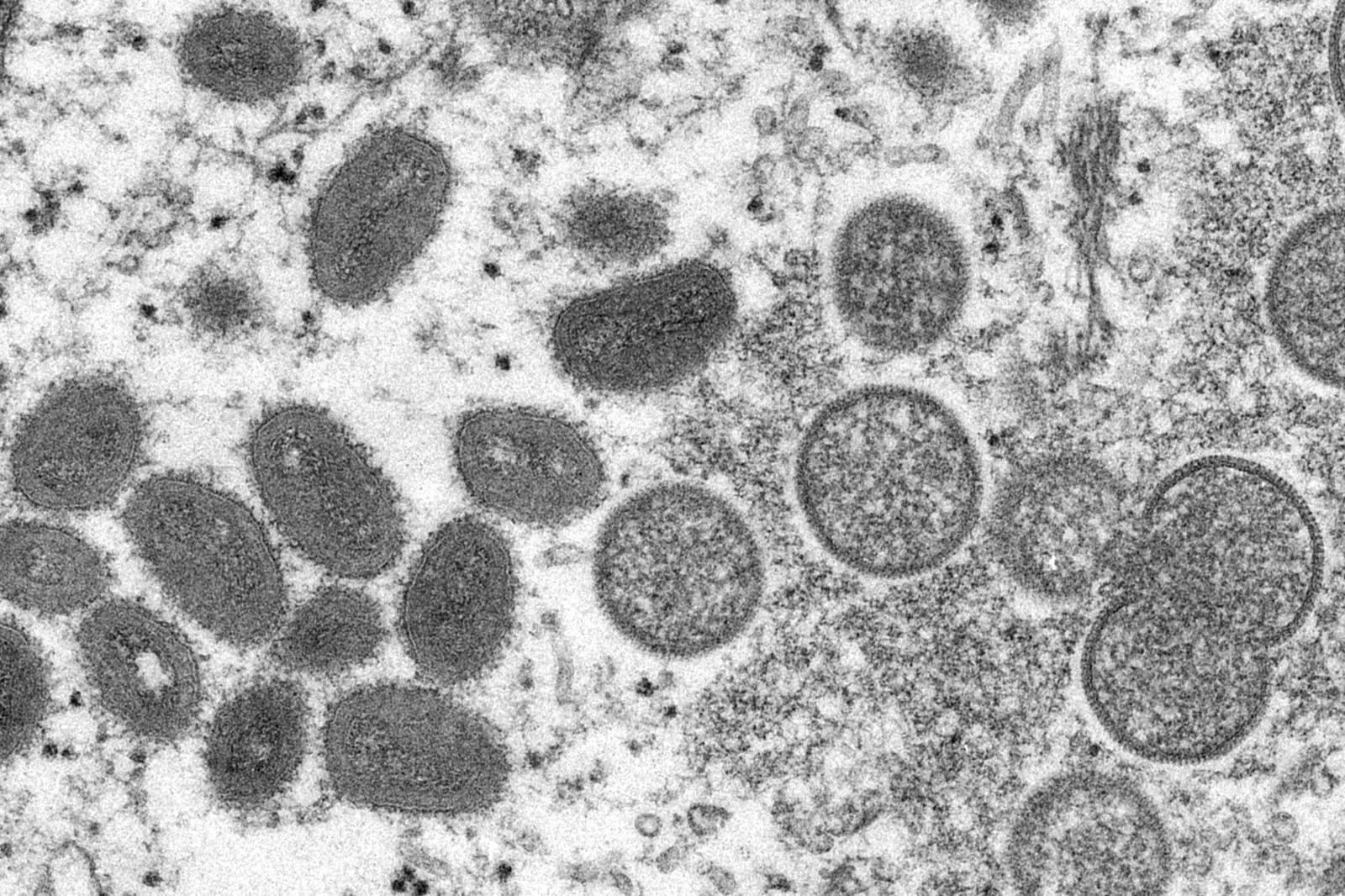 پون: ICMR-NIV سویه A.2 ویروس آبله میمون را در دو مسافر بازگشته امارات نشان داد