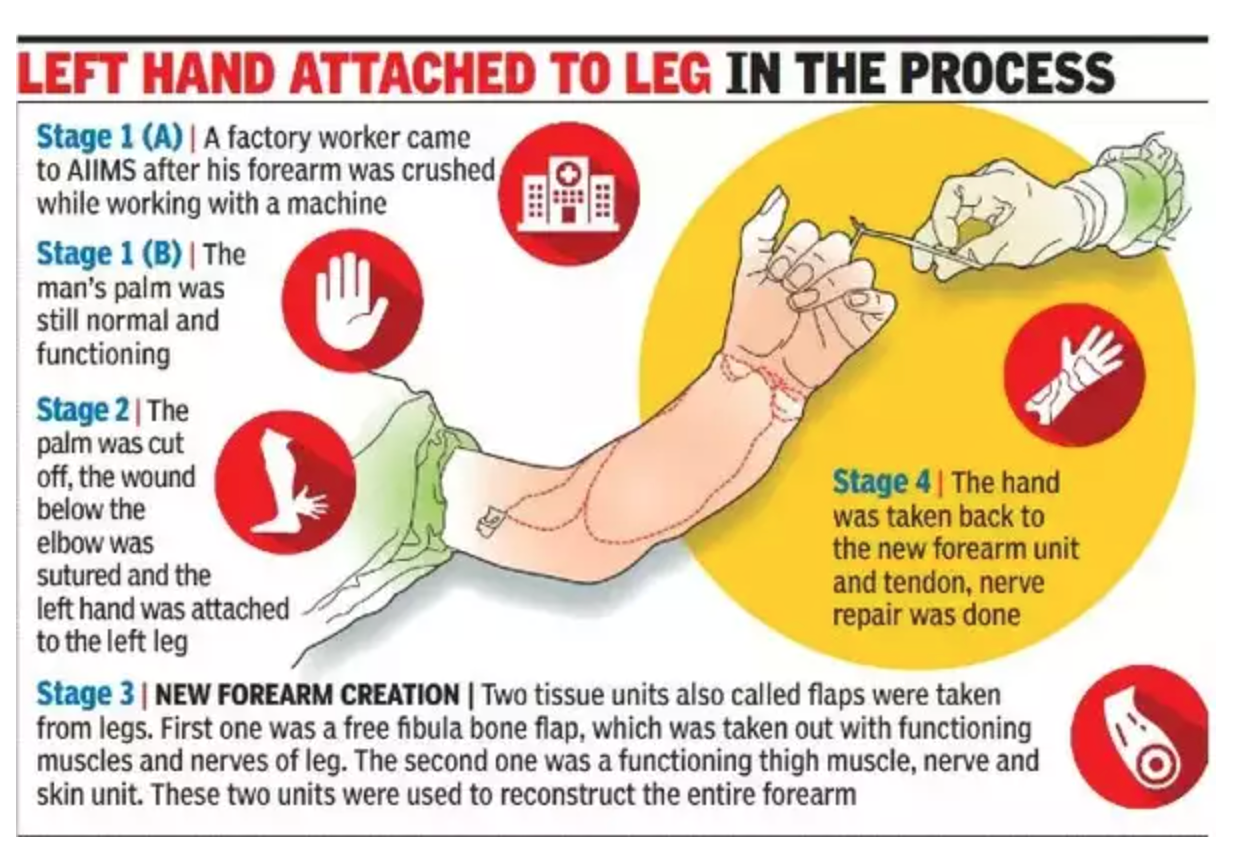 AIIMS constructs new forearm over 3 years
