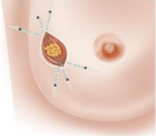 مطالعه TMC: تجویز بیهوشی قبل از جراحی سرطان پستان می تواند میزان بقا را بهبود بخشد