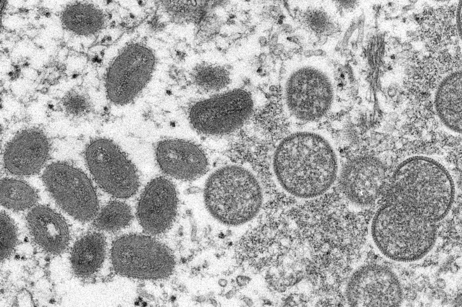 Mutations have made monkeypox 'smarter': Indian-origin scientists
