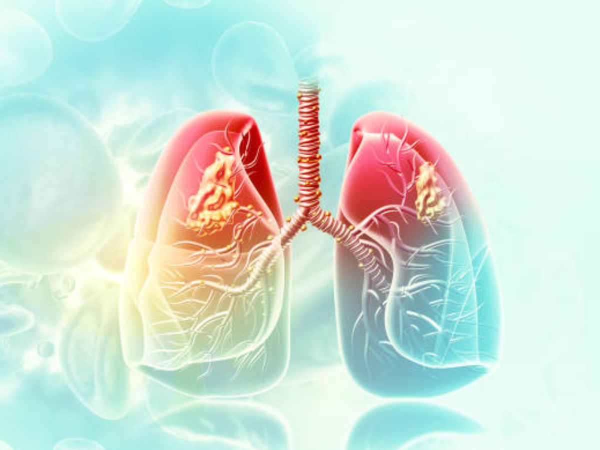 Detecting lung cancer early using biopsy devices critical to improving recovery rates: GlobalData