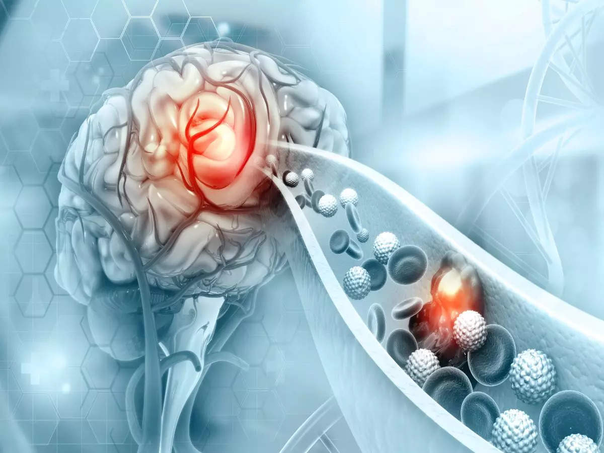 Study reveals how vortex ultrasound breaks down blood clots in brain