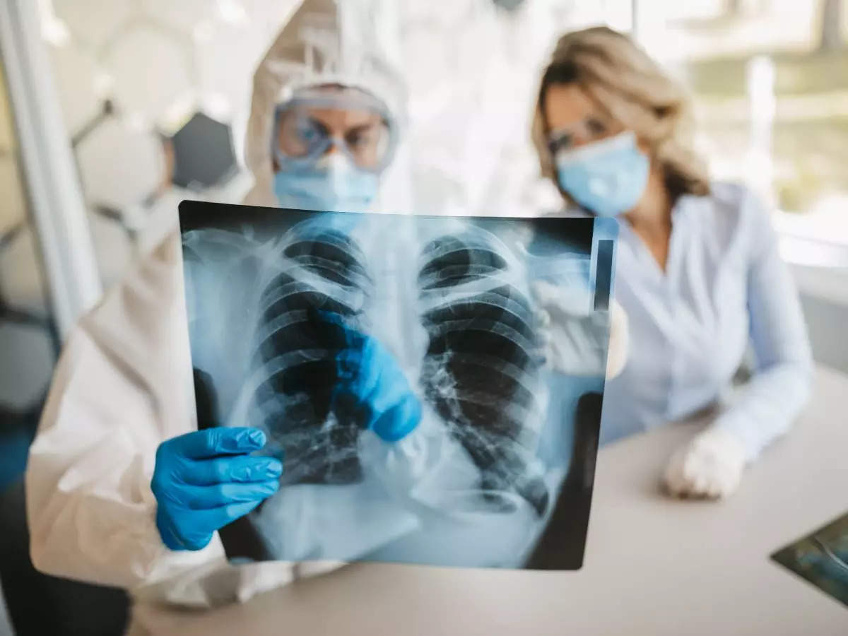 Chest CT scans reveal lung abnormalities in patients 2 years after Covid: Study