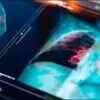 Researchers find genetic answer to lung cancer in those who never smoked
