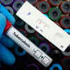 New tool can predict TB death risk at diagnosis, says study