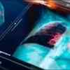 Global lung cancer screening lessons offer roadmap for India: AIIMS expert