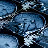 Brain disorders associated with increased brain ageing: Study