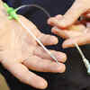 Health ministry asked to examine coronary stent safety concerns