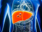 Image thumb liver cancer to double worldwide most of it preventable study
