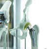 India plans national registry to track implantable medical devices, patients
