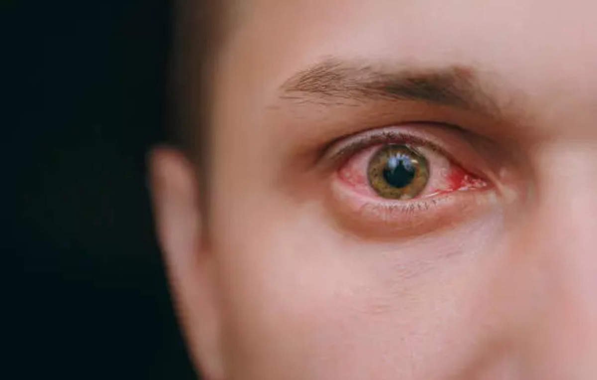 Pink eye: Adenovirus pressure inflicting surge – ET HealthWorld