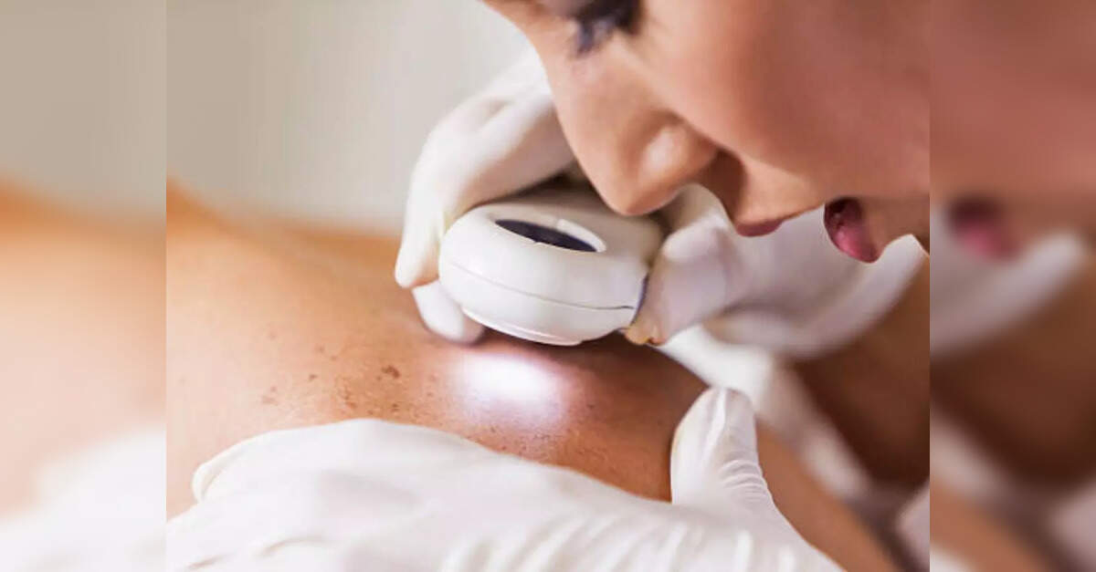 Lirentelimab: Allakos to drop skin disease drug after mid-stage studies ...