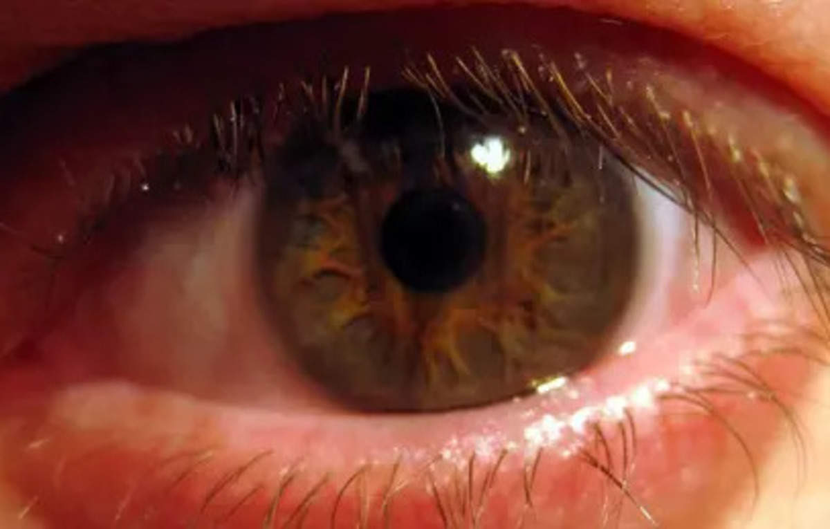 gut-bacteria-may-cause-blindness-due-to-some-inherited-eye-conditions