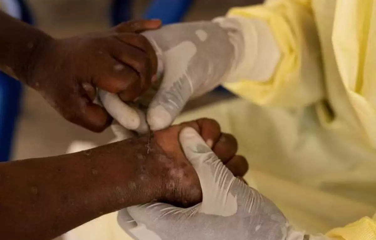 WHO chief mulls calling emergency committee on mpox, ET HealthWorld