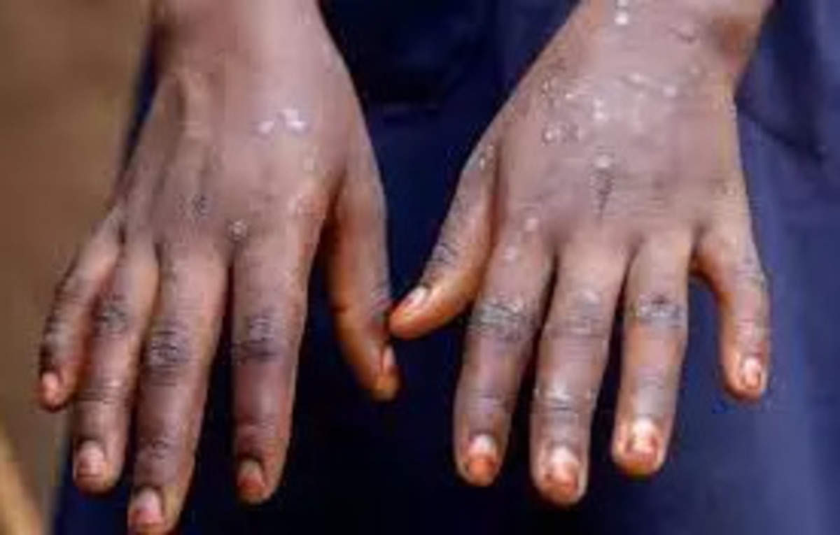 Mpox cases on African continent show 500% increase year-on-year, ET HealthWorld